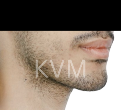 Charlie - After Jaw Surgery