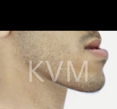 Charlie - Before Jaw Surgery