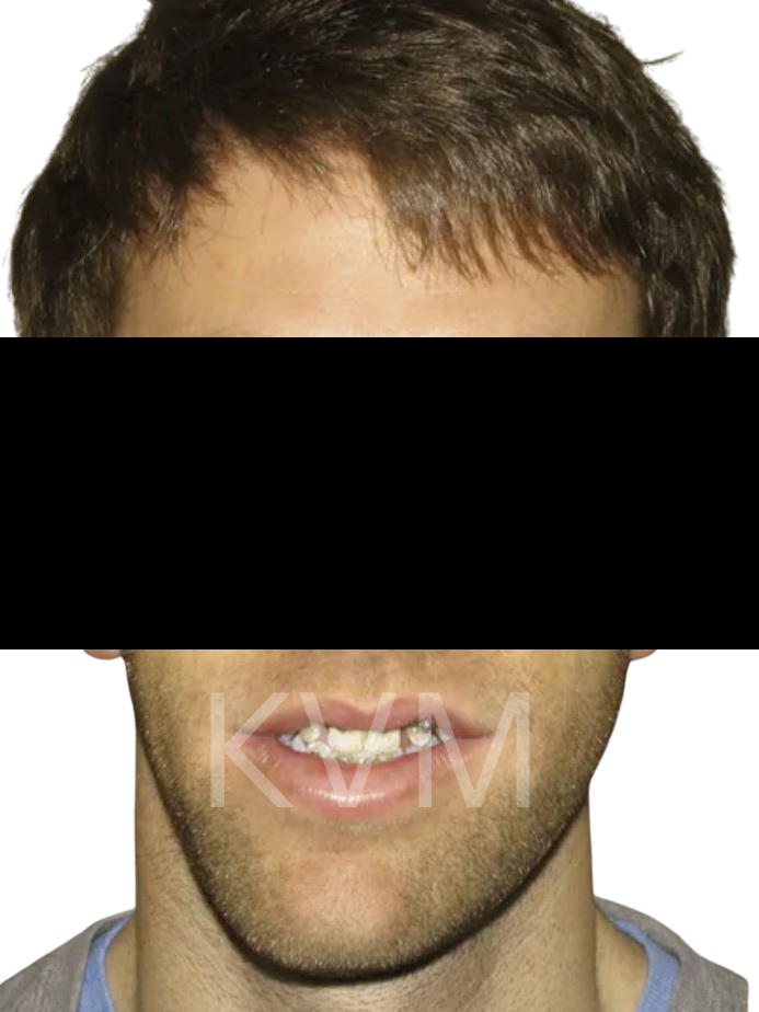 Ryan - Before Jaw Surgery