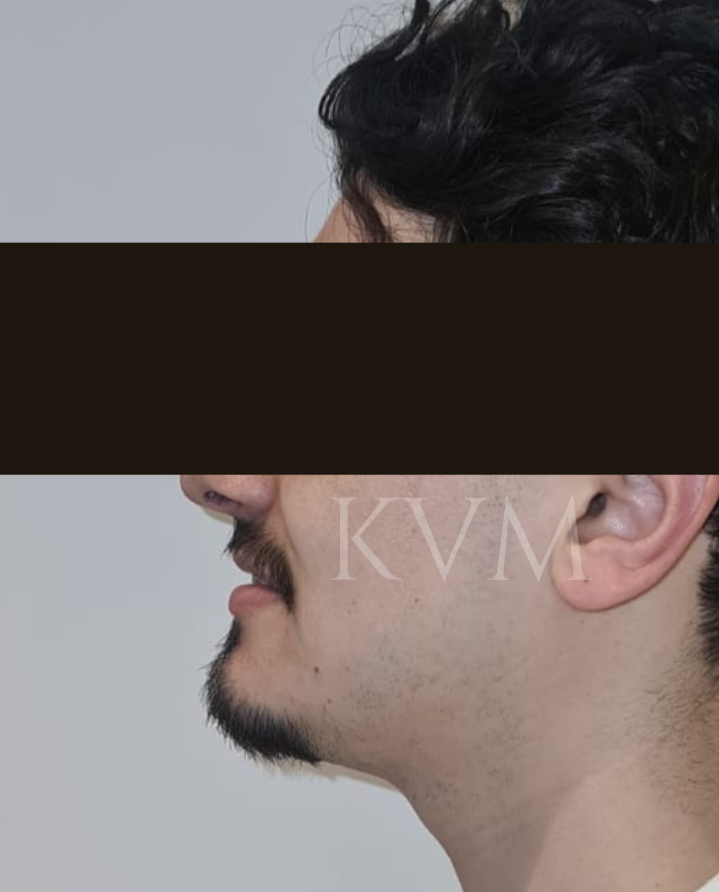 Jared - After Jaw Surgery