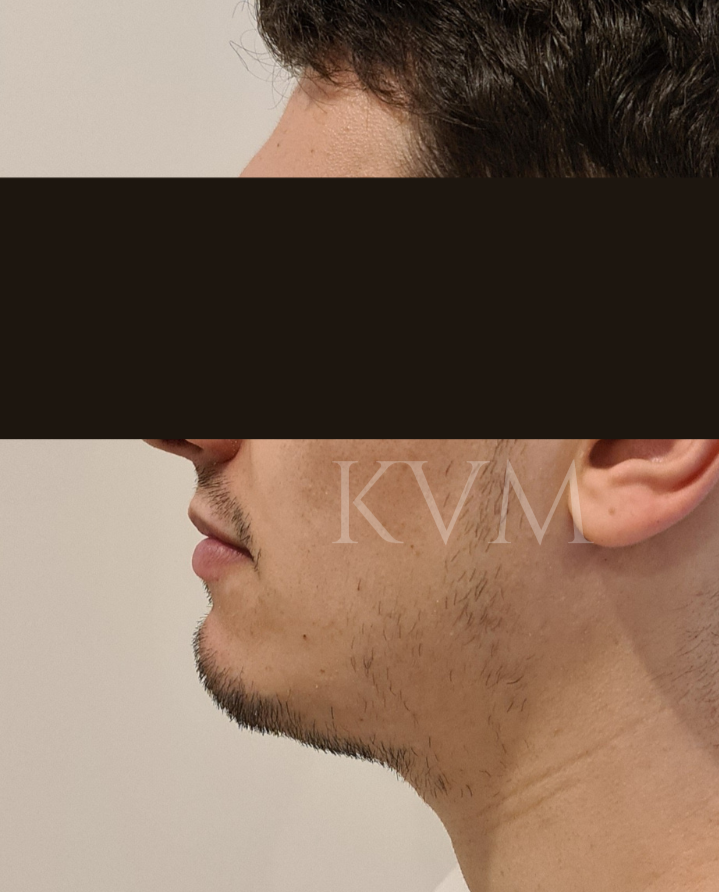 Jared- Before Jaw Surgery