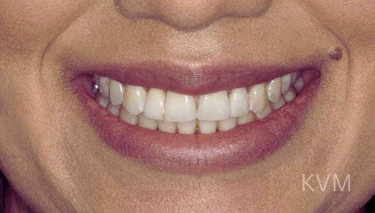Karen - After incisor