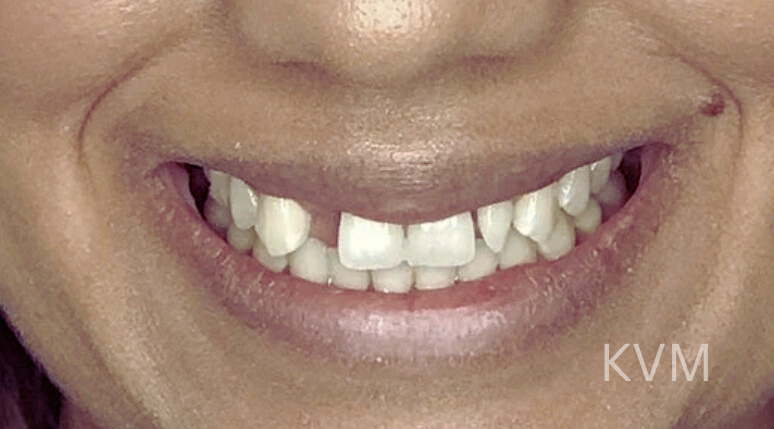 Karen - Before Incisor