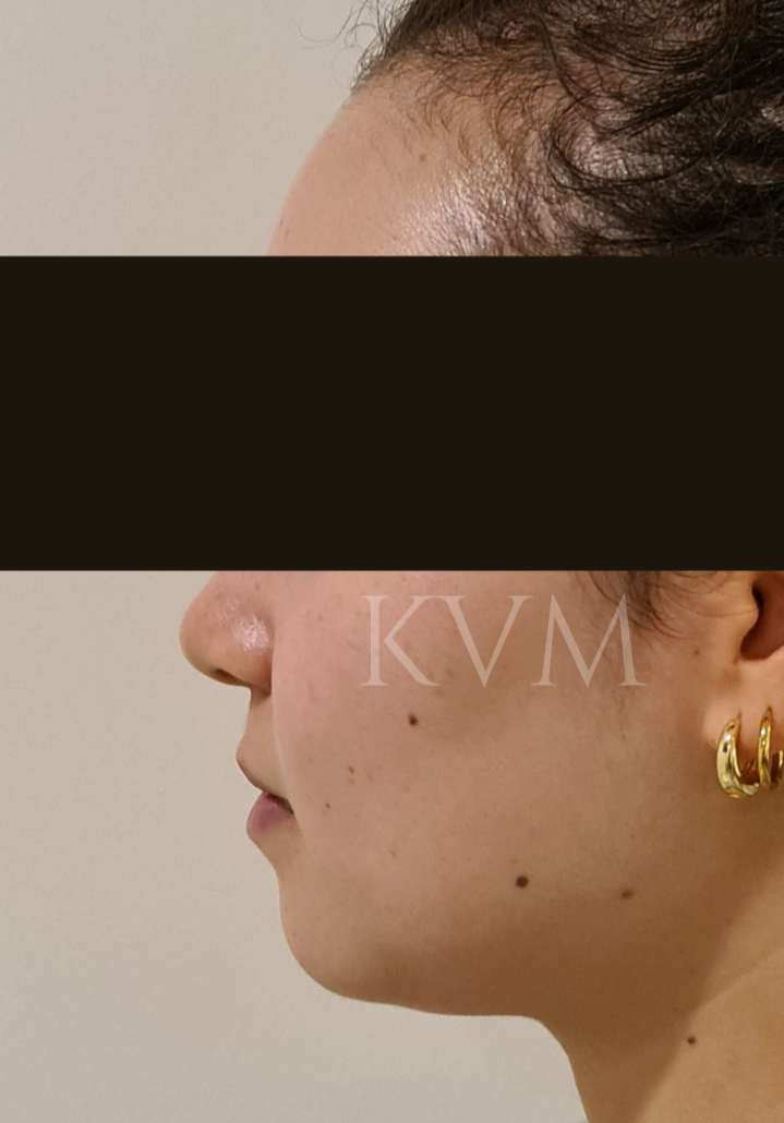 Claire - After Jaw Surgery