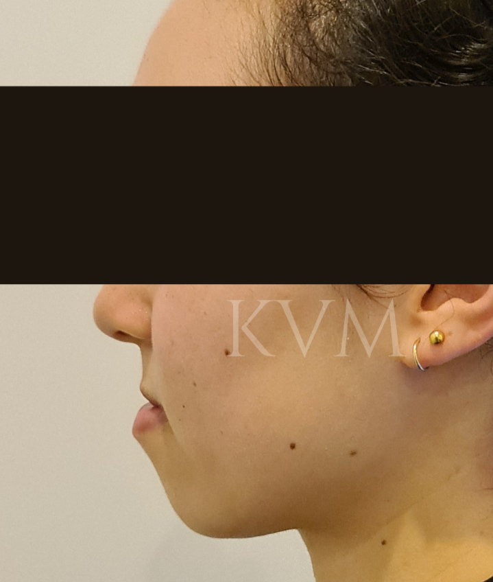 Claire - Before Jaw Surgery