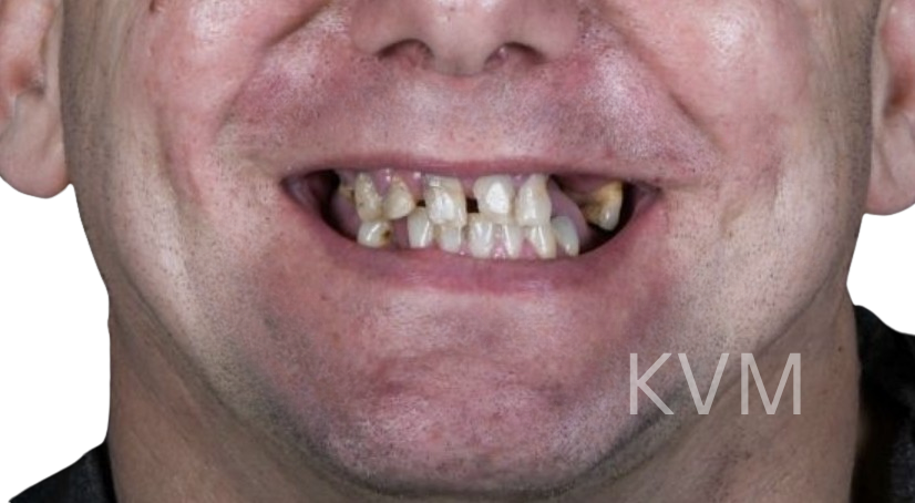 Mitch - Before All on 4 implants