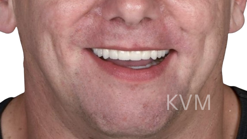 Mitch - After All on 4 implants