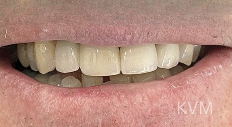 Rich - After central incisor