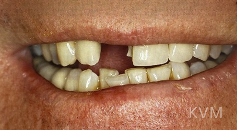 Rich - Before central incisor
