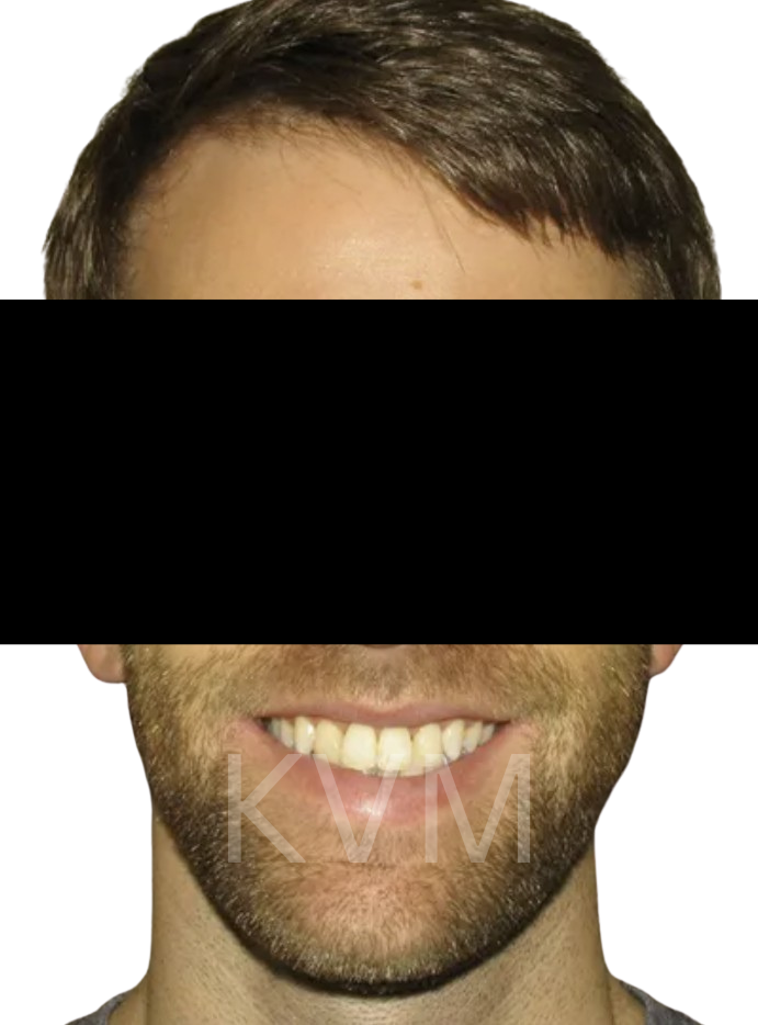 Ryan - After Jaw Surgery