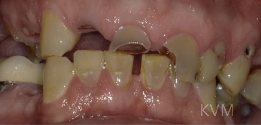 Sam - Before All on 4 implants