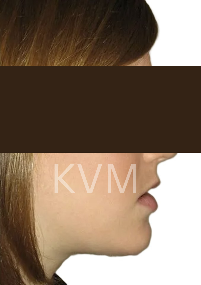 Sarah - After Jaw Surgery