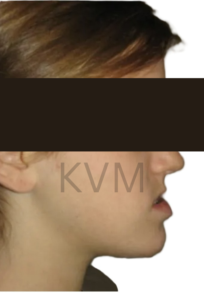 Sarah - Before Jaw Surgery