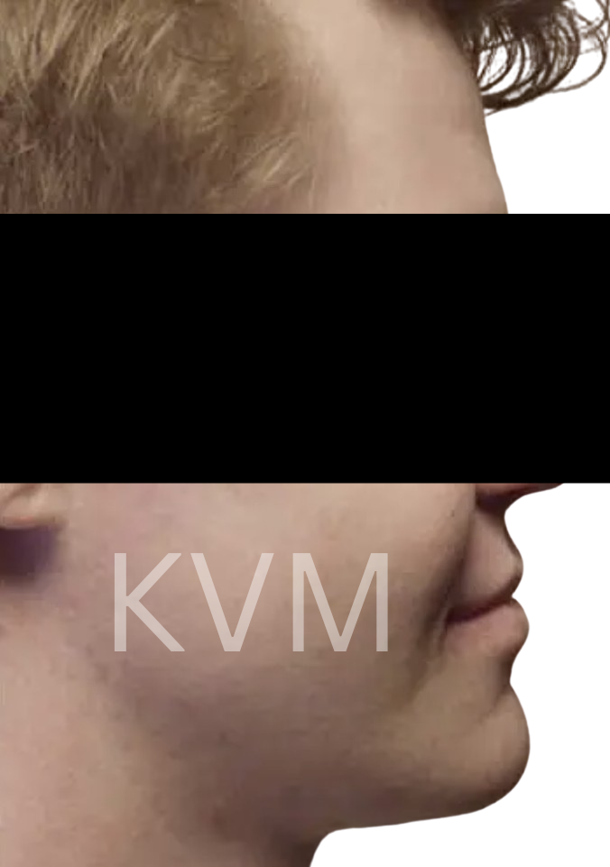 Tom - After Jaw Surgery