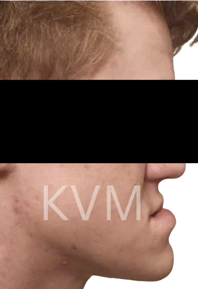 Tom - Before Jaw Surgery