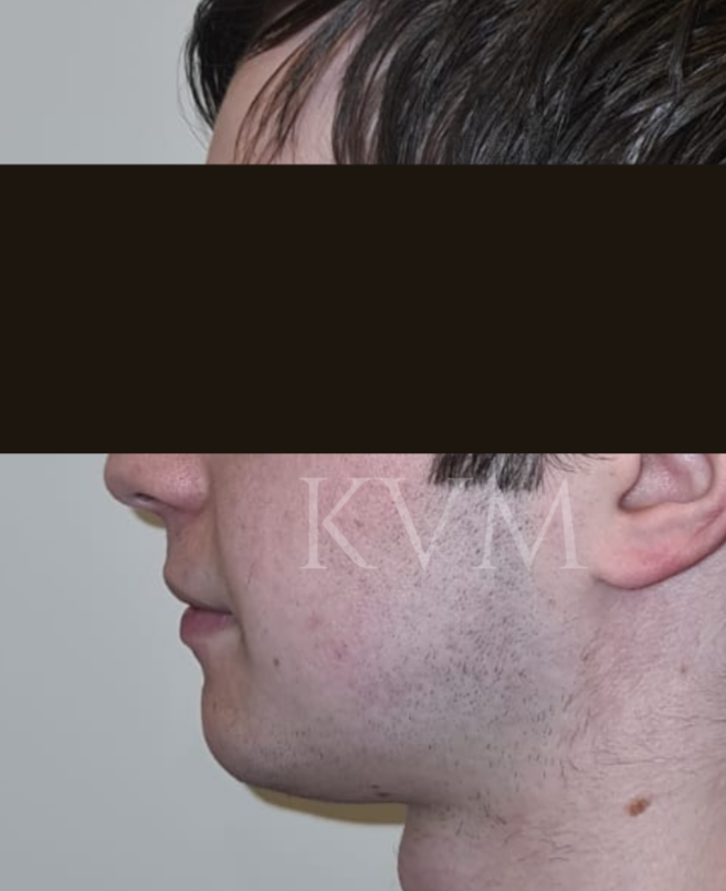 Sam - After Jaw Surgery