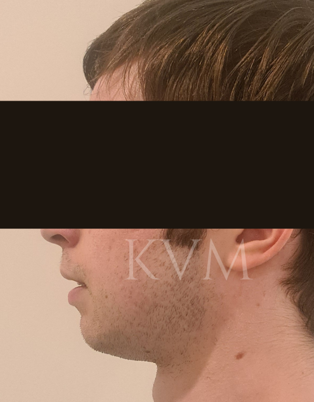 Sam - Before Jaw Surgery