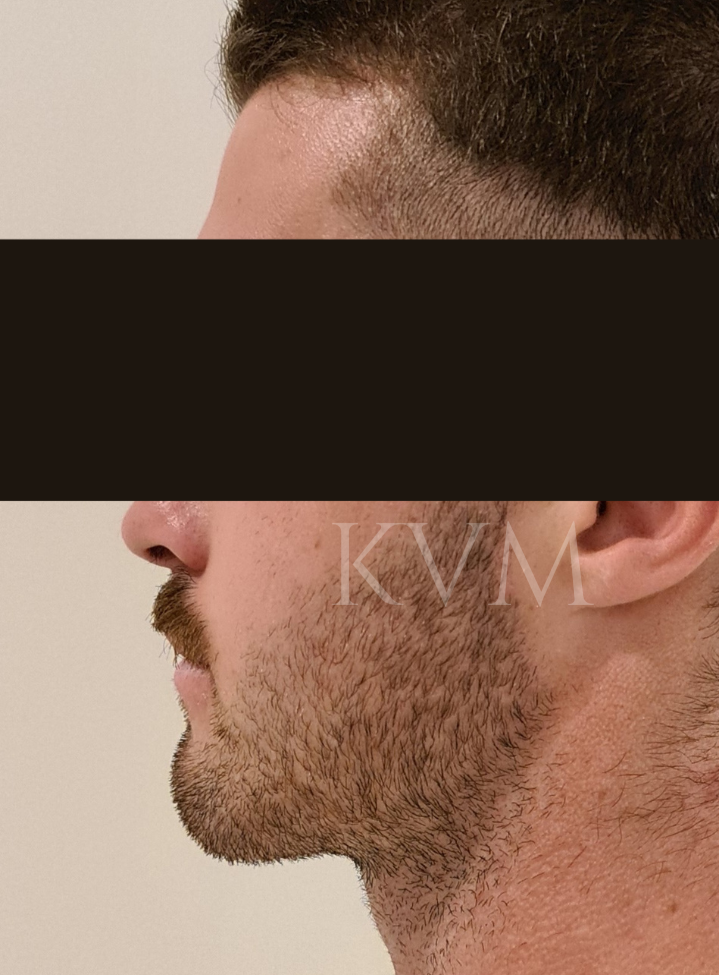 Tim - After Jaw Surgery