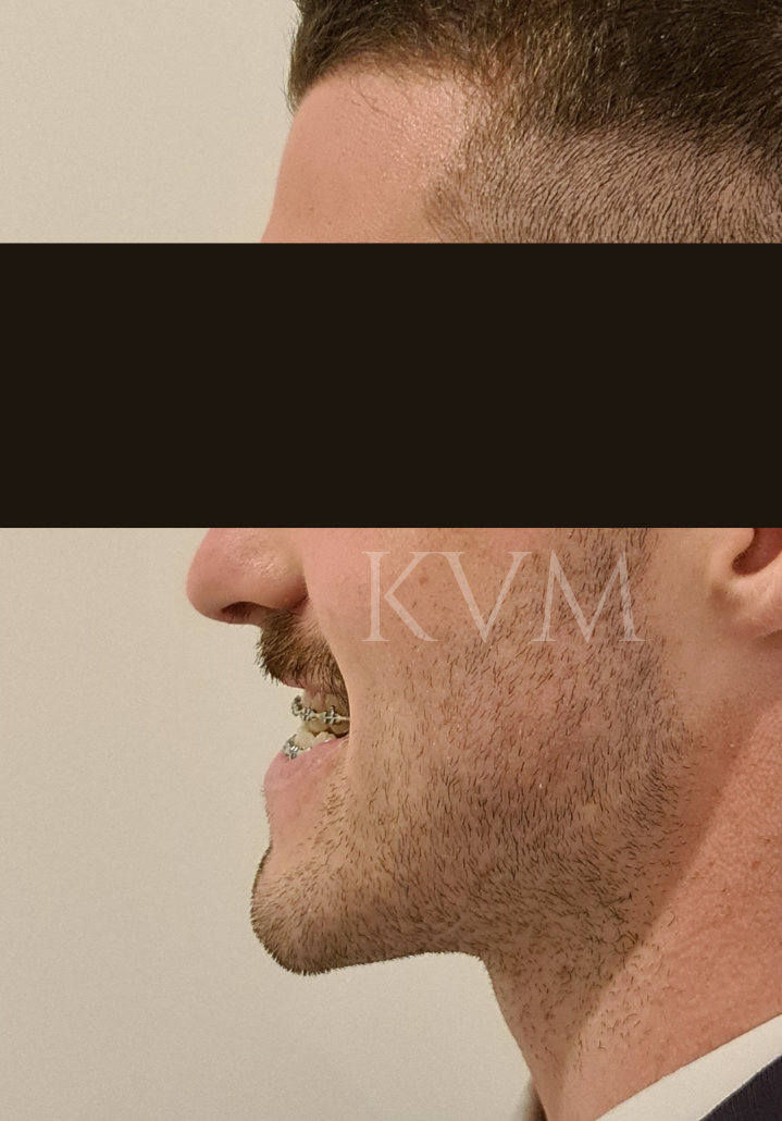 Tim - Before Jaw Surgery