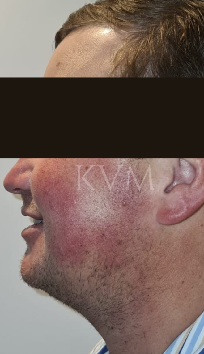 Craig - After Jaw Surgery