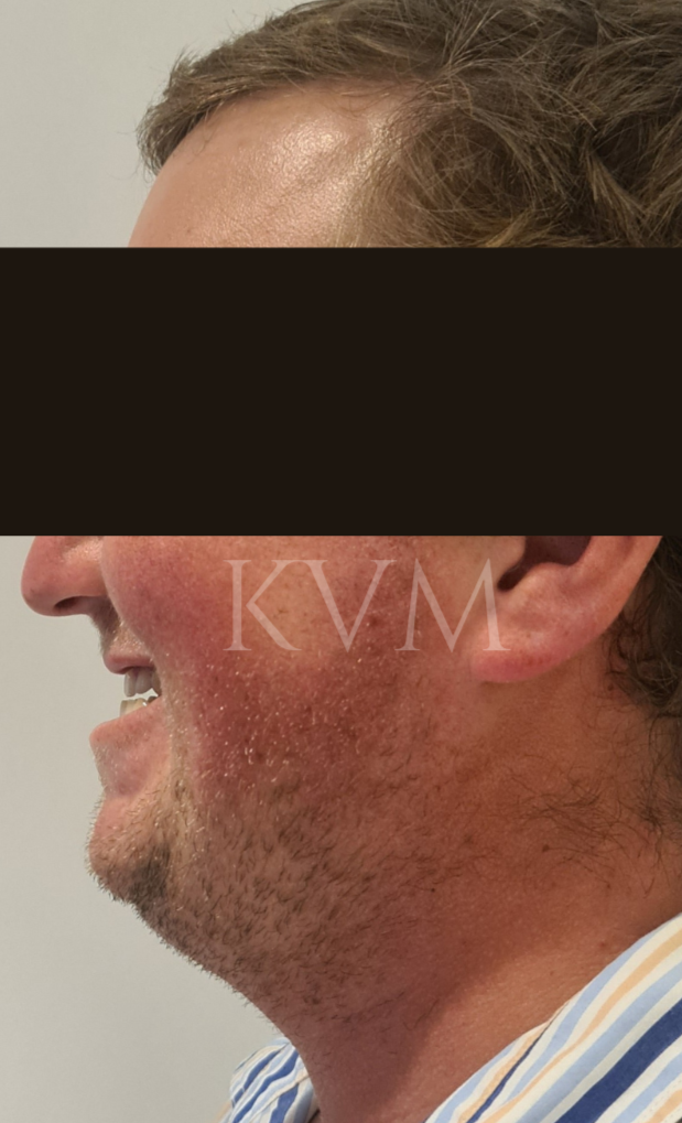 Craig - Before Jaw Surgery