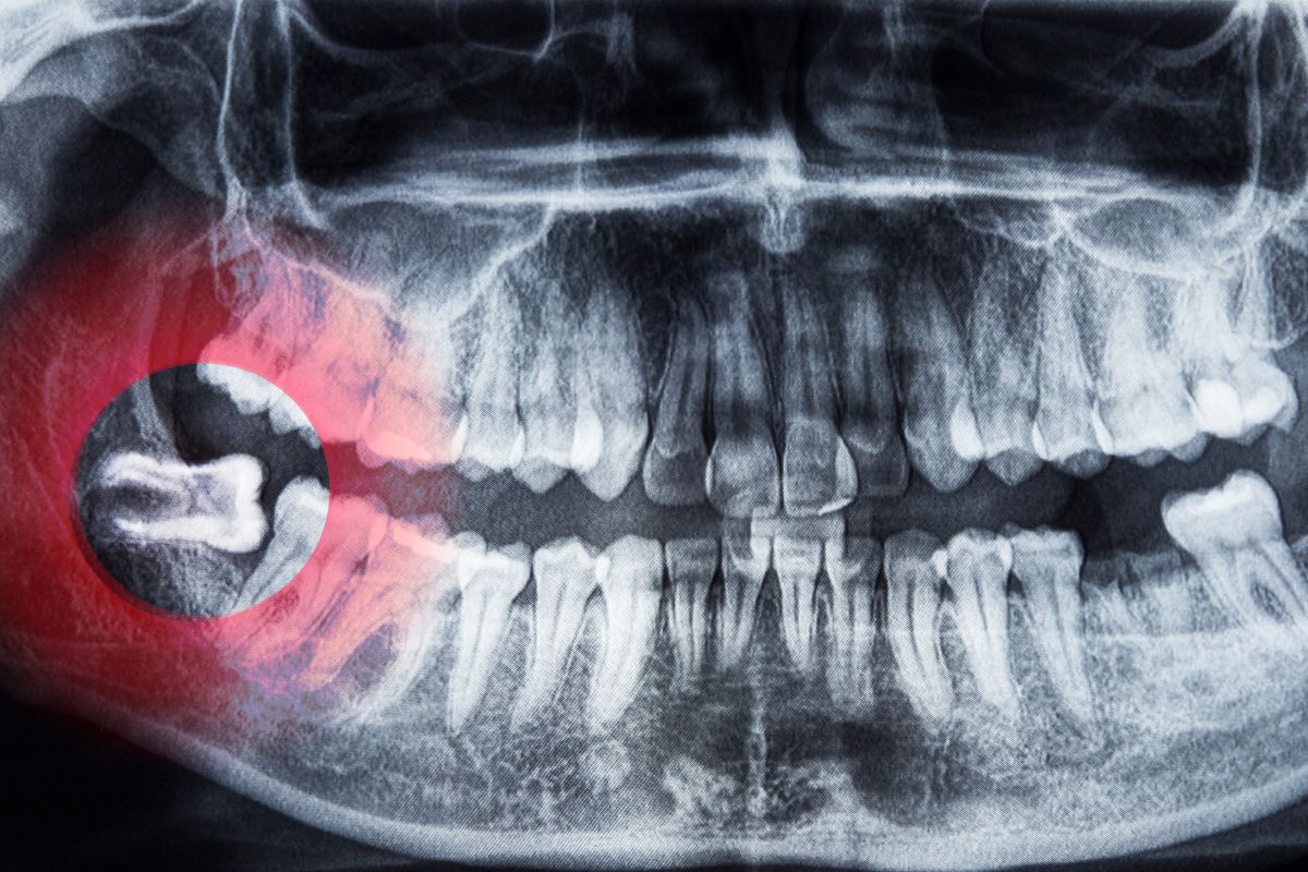 wisdom tooth removal