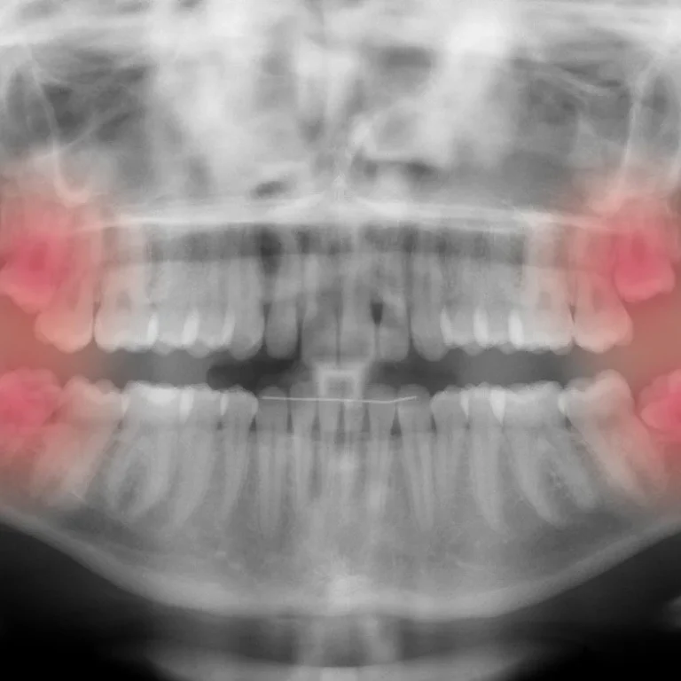 Wisdom+Tooth+Surgery+Northern+Beaches+Dr+Chellappah