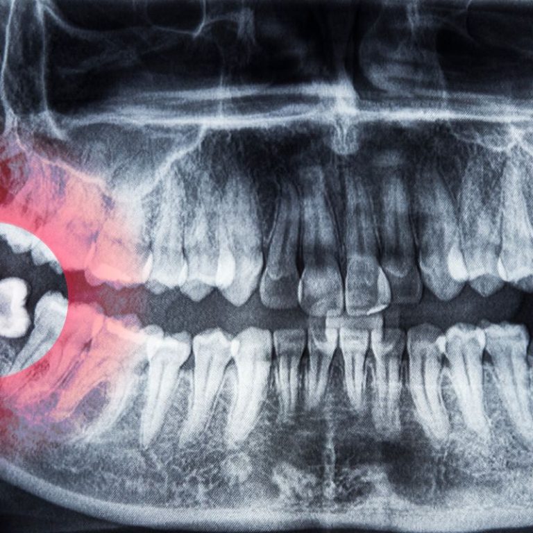 wisdom tooth removal